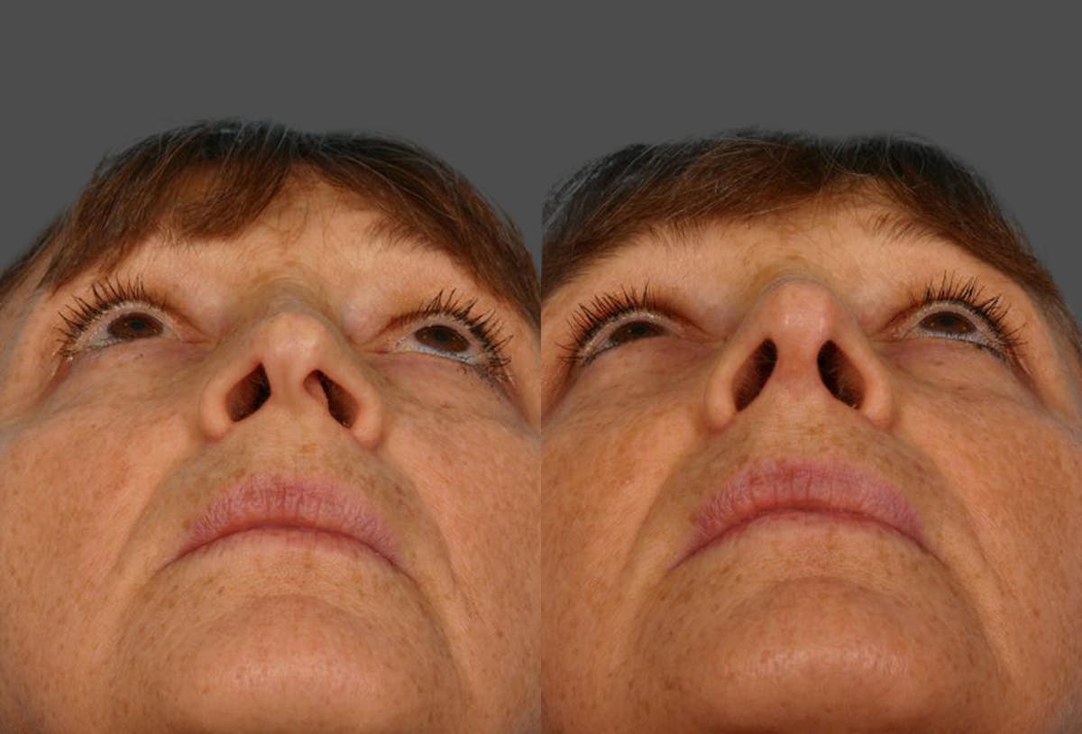 Nasal Obstruction Before & After Gallery - Patient 377226 - Image 3