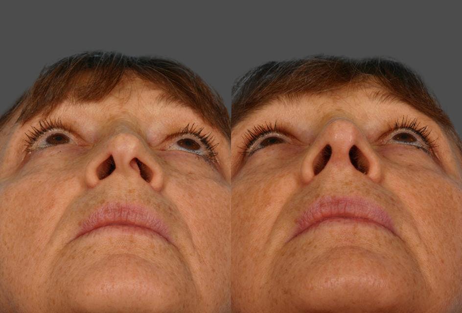 Nasal Obstruction Before & After Gallery - Patient 377226 - Image 3