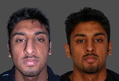 Rhinoplasty Before & After Gallery - Patient 172093 - Image 1