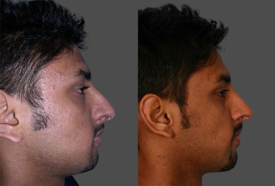 Nasal Obstruction Before & After Gallery - Patient 379882 - Image 2