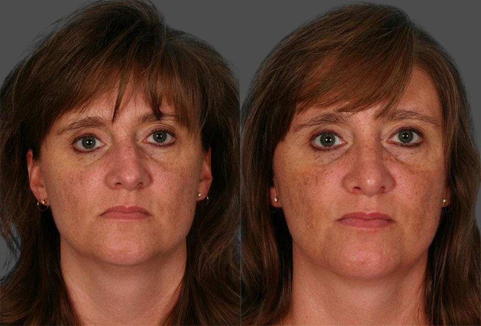 Rhinoplasty Before & After Gallery - Patient 298177 - Image 1