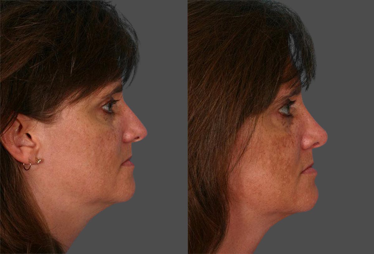 Rhinoplasty Before & After Gallery - Patient 298177 - Image 2