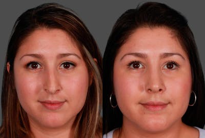 Rhinoplasty Before & After Gallery - Patient 172370 - Image 1