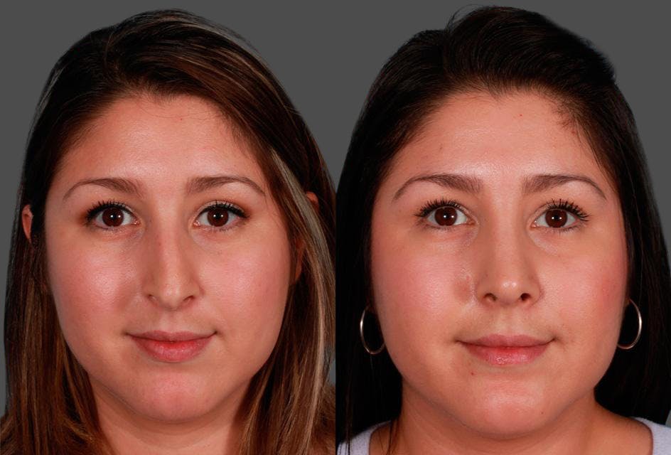 Rhinoplasty Before & After Gallery - Patient 172370 - Image 1