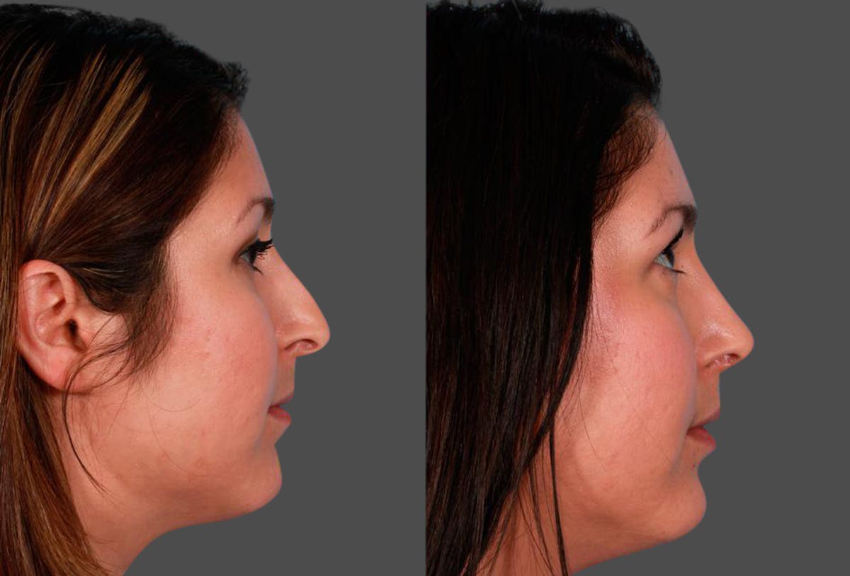 Nasal Obstruction Before & After Gallery - Patient 390109 - Image 2