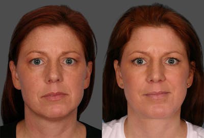 Rhinoplasty Before & After Gallery - Patient 187096 - Image 1