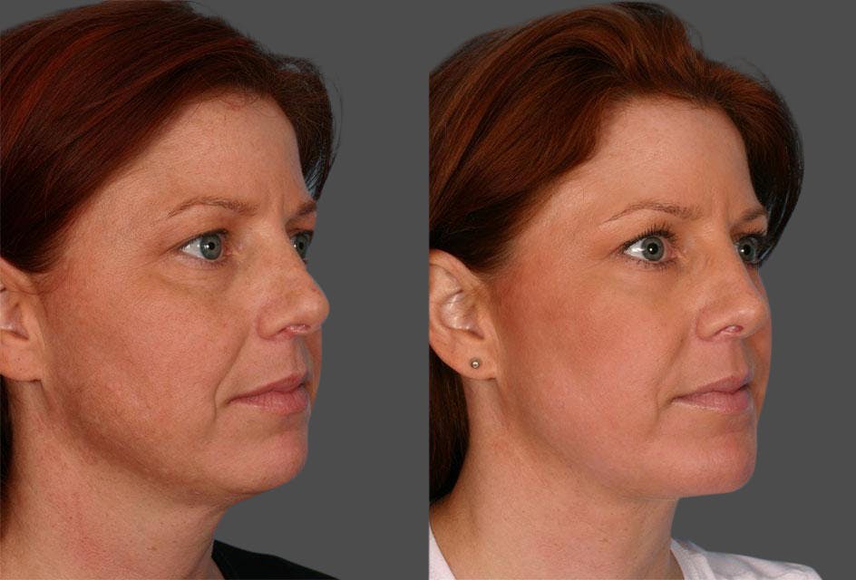 Rhinoplasty Before & After Gallery - Patient 389866 - Image 2