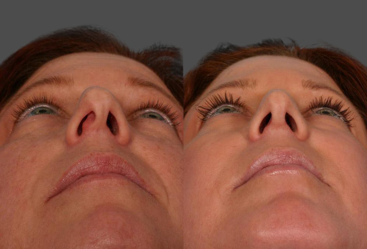 Rhinoplasty Before & After Gallery - Patient 187096 - Image 4