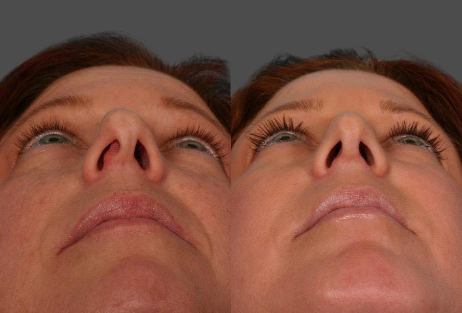Rhinoplasty Before & After Gallery - Patient 187096 - Image 4
