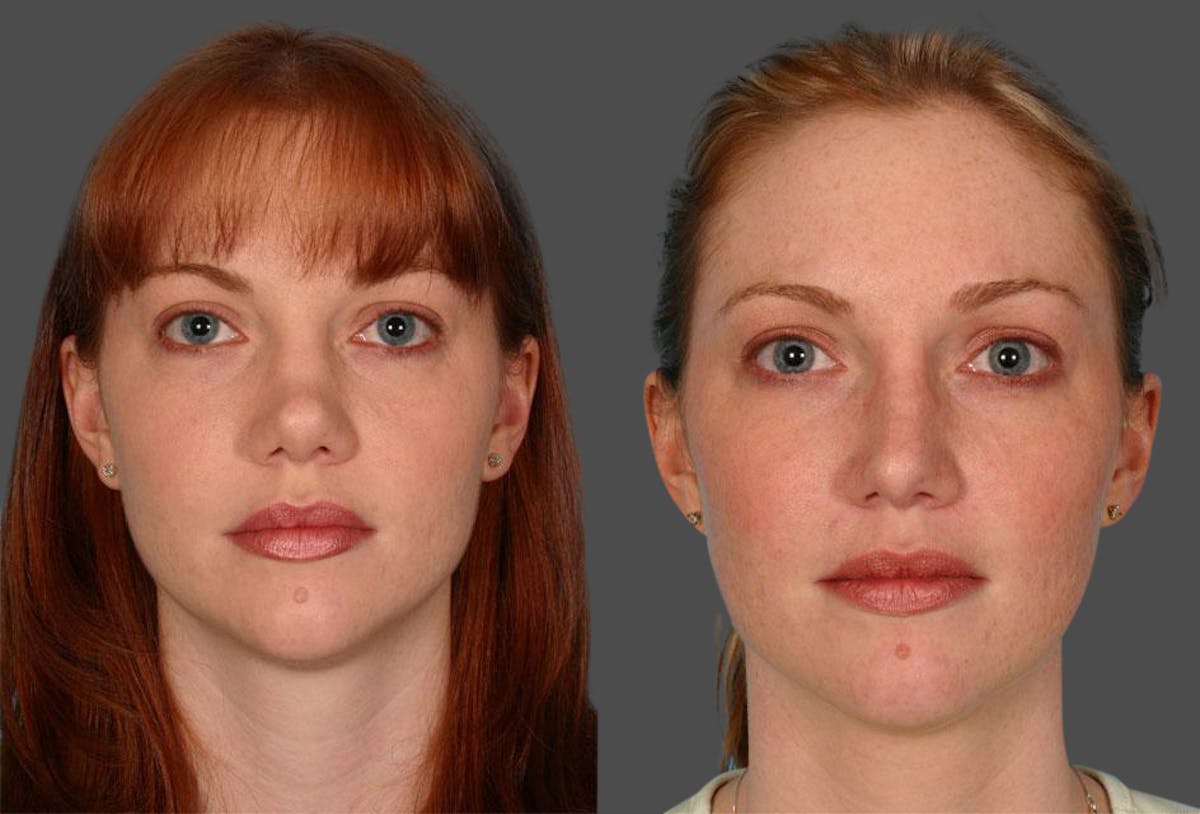 Nasal Obstruction Before & After Gallery - Patient 419637 - Image 1