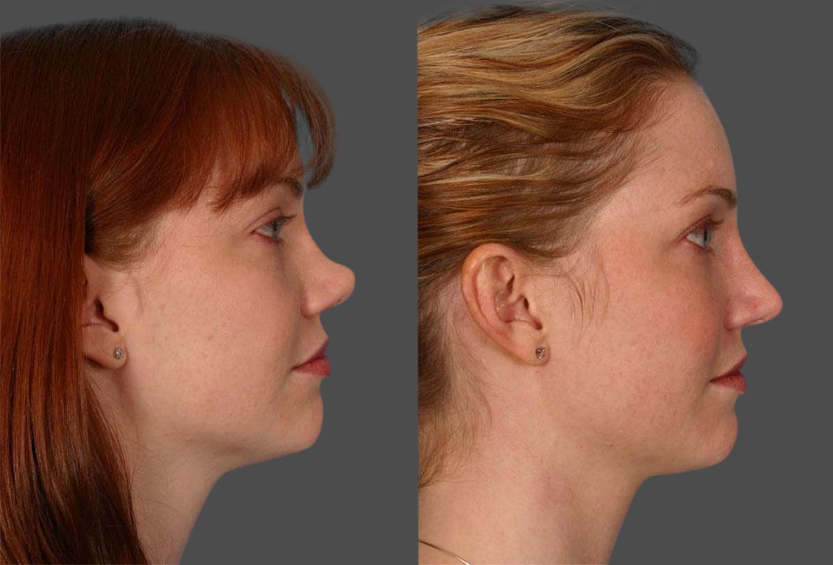 Nasal Obstruction Before & After Gallery - Patient 419637 - Image 2