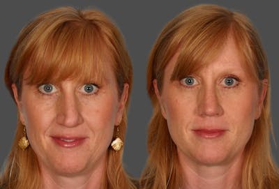 Rhinoplasty Before & After Gallery - Patient 343469 - Image 1