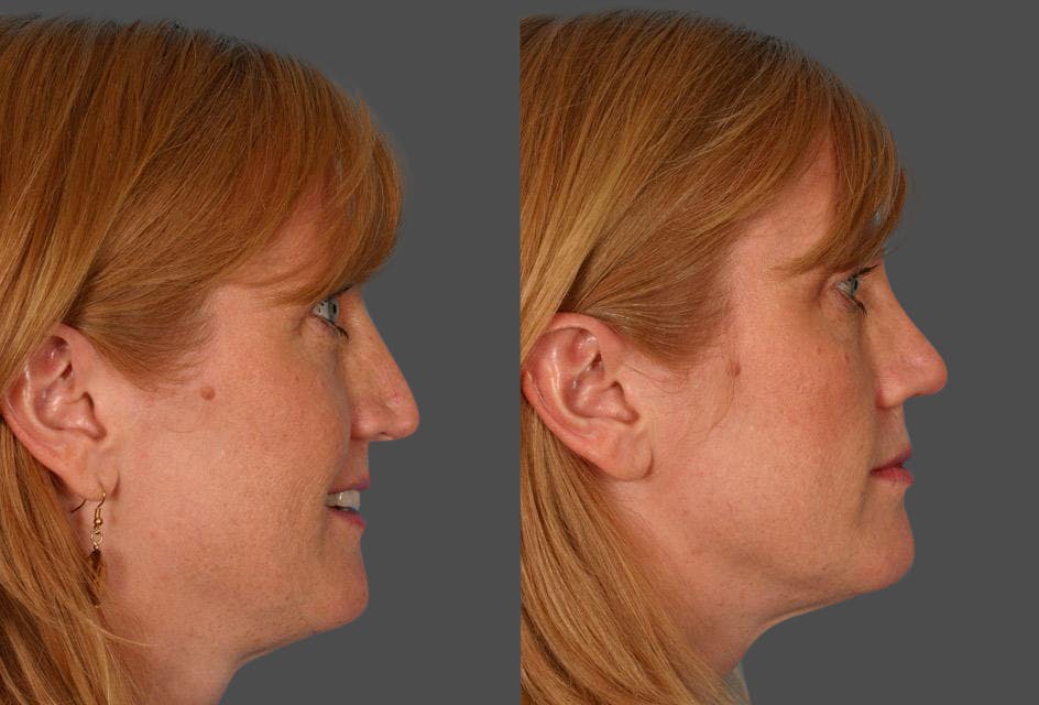 Nasal Obstruction Before & After Gallery - Patient 419717 - Image 2