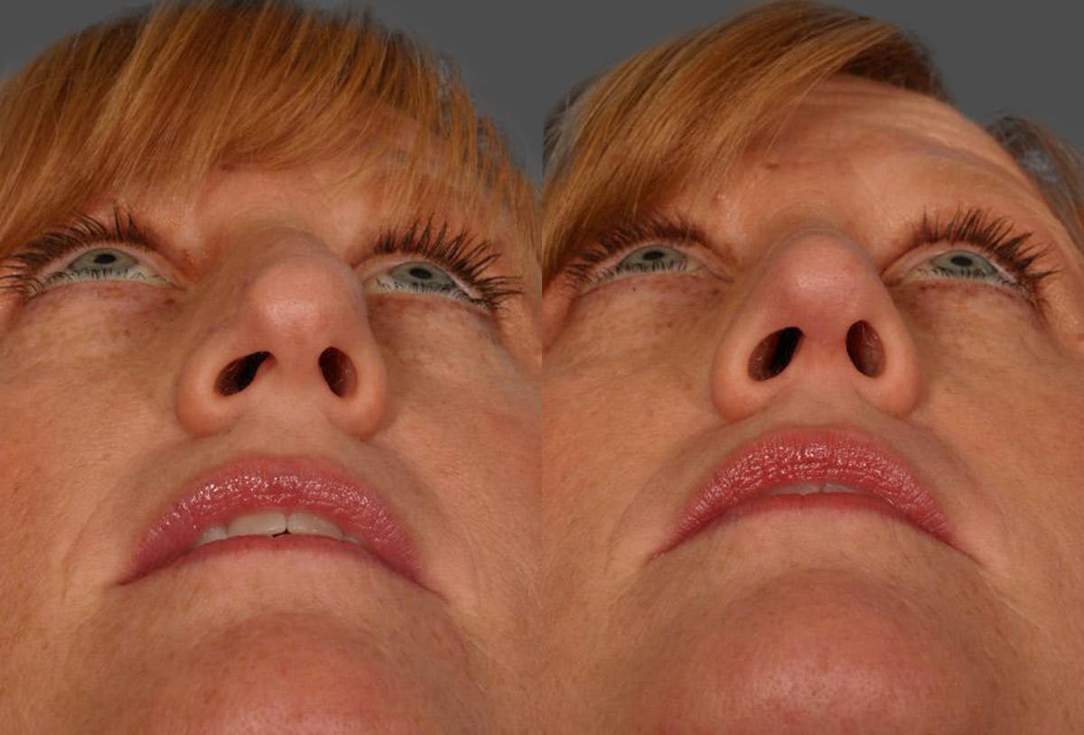 Nasal Obstruction Before & After Gallery - Patient 419717 - Image 3