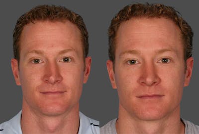 Rhinoplasty Before & After Gallery - Patient 249063 - Image 1
