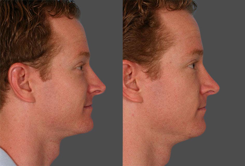 Rhinoplasty Before & After Gallery - Patient 249063 - Image 2