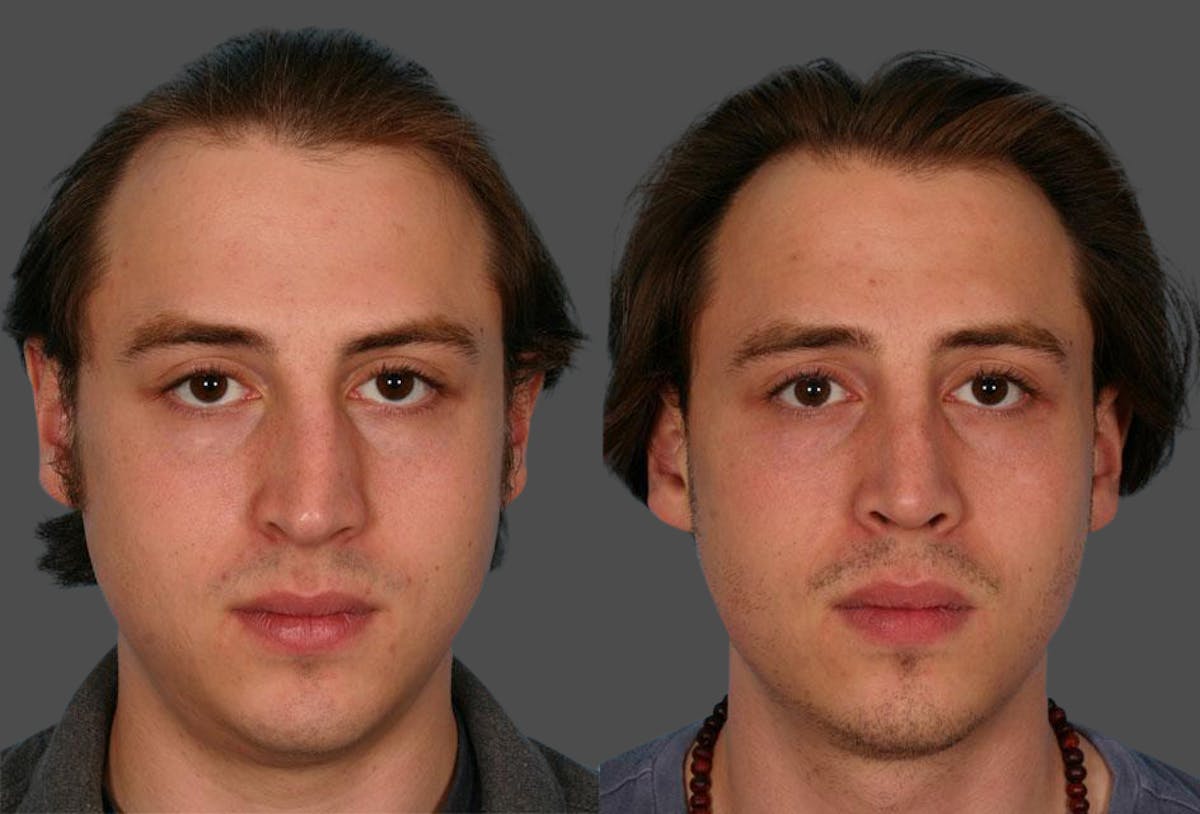 Rhinoplasty Before & After Gallery - Patient 402940 - Image 1