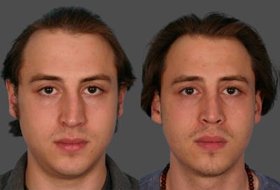 Rhinoplasty Before & After Gallery - Patient 402940 - Image 1