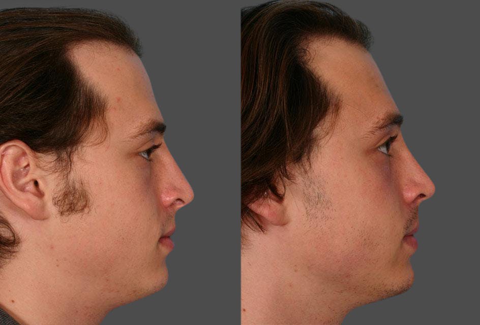 Rhinoplasty Before & After Gallery - Patient 402940 - Image 2