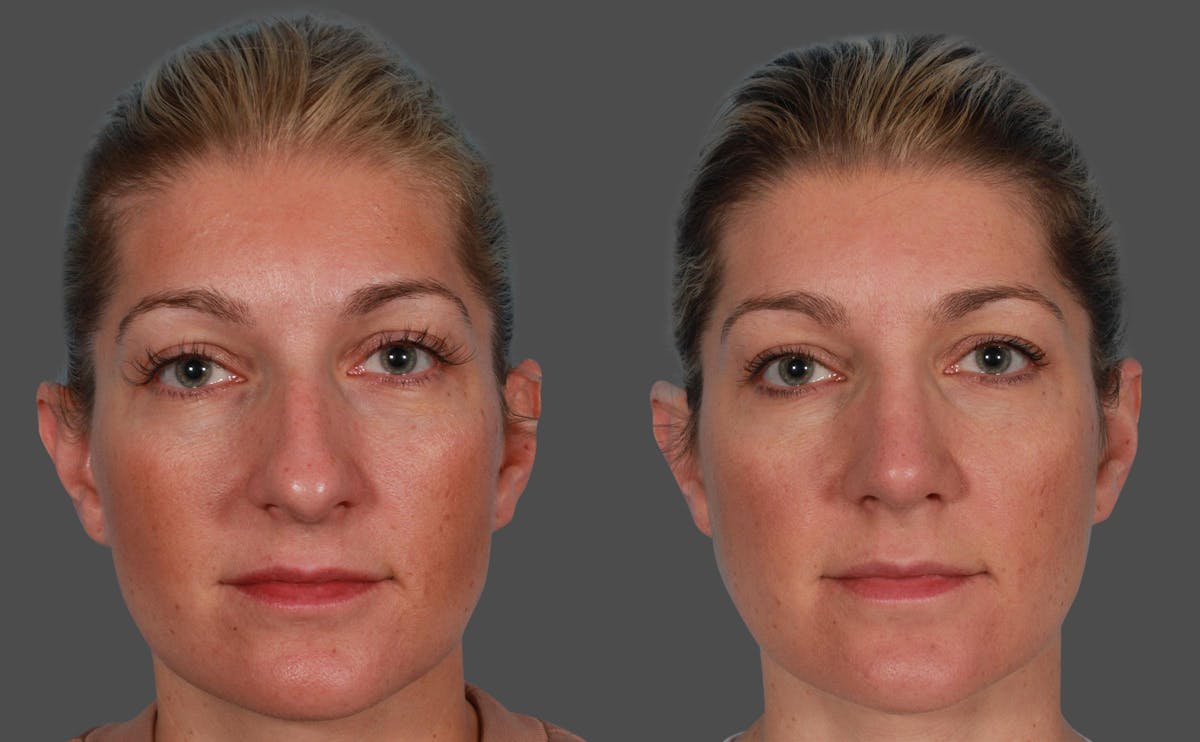 Nasal Obstruction Before & After Gallery - Patient 757894 - Image 1