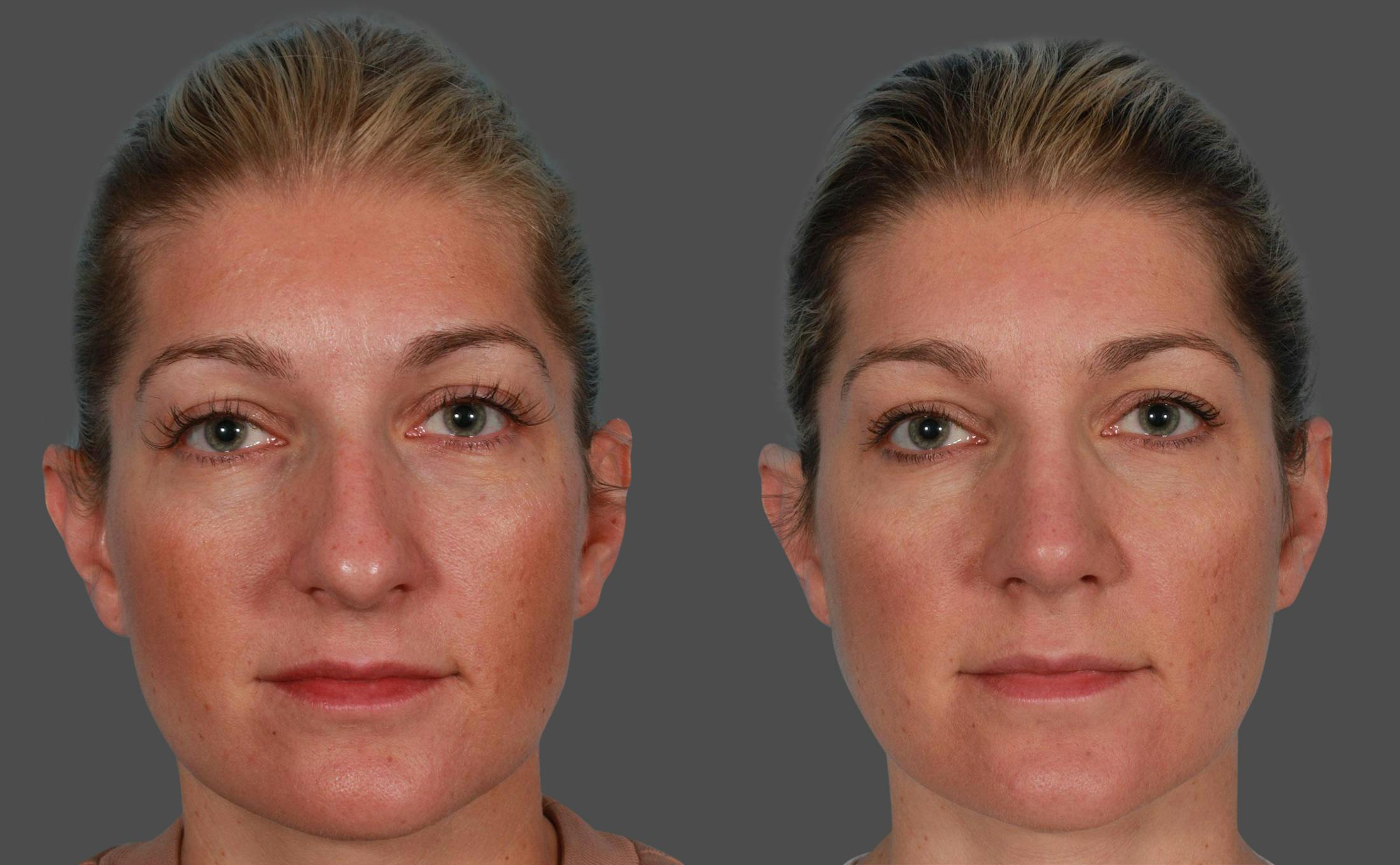 Nasal Obstruction Before & After Gallery - Patient 757894 - Image 1