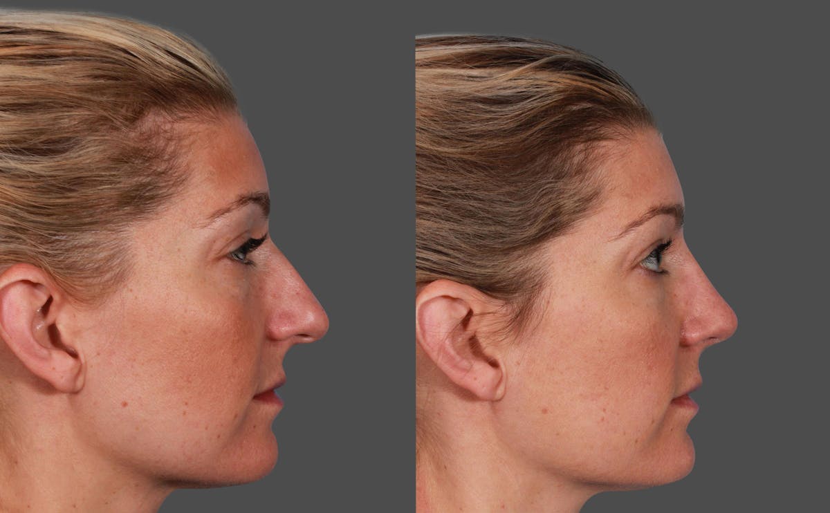 Nasal Obstruction Before & After Gallery - Patient 757894 - Image 2