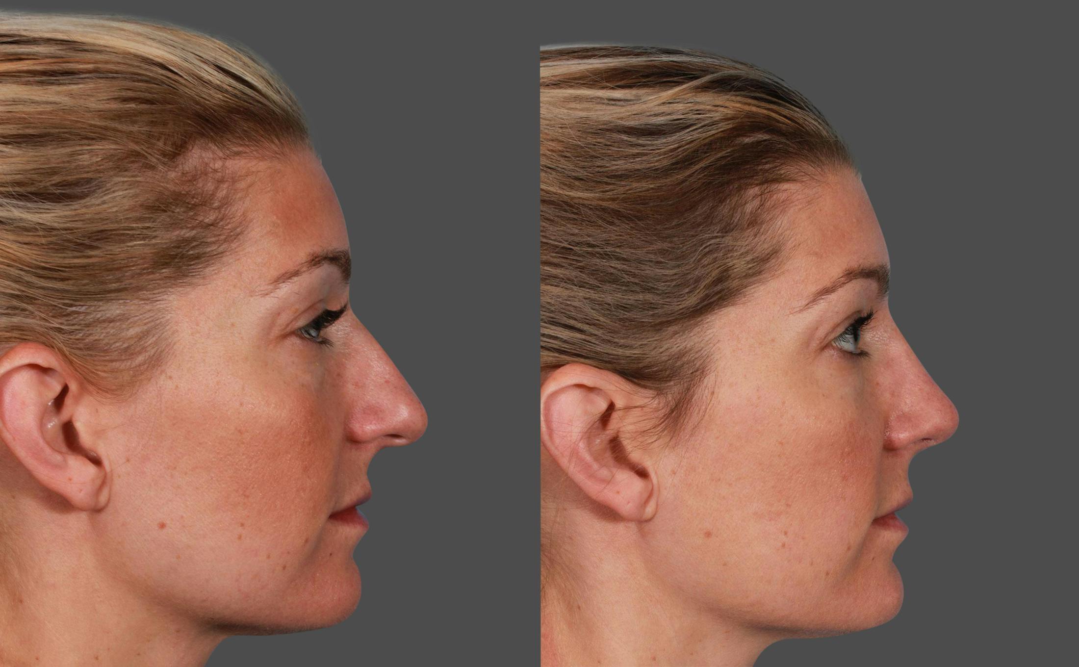 Nasal Obstruction Before & After Gallery - Patient 757894 - Image 2