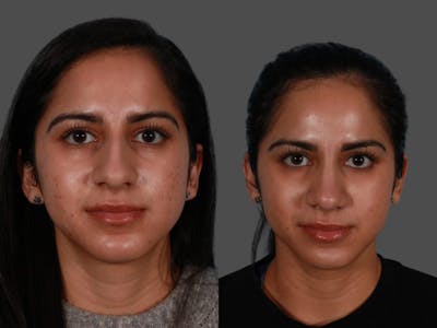 Nasal Obstruction Before & After Gallery - Patient 874593 - Image 1