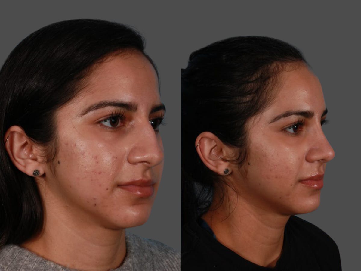 Nasal Obstruction Before & After Gallery - Patient 874593 - Image 2