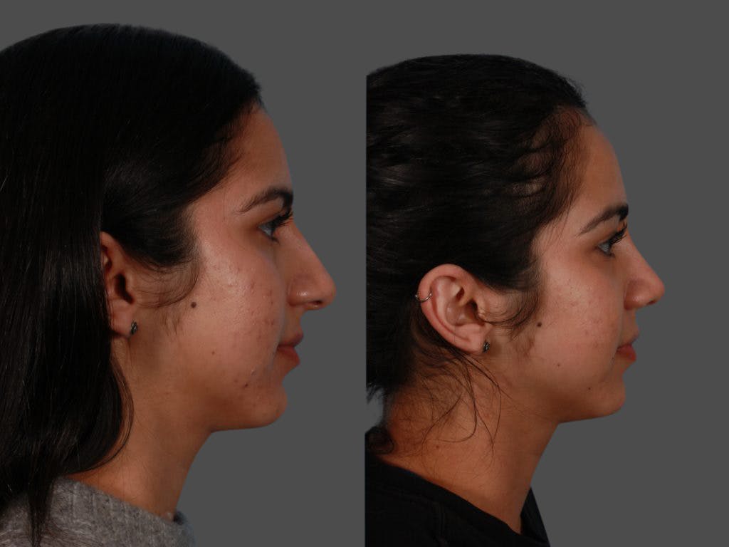 Nasal Obstruction Before & After Gallery - Patient 874593 - Image 3