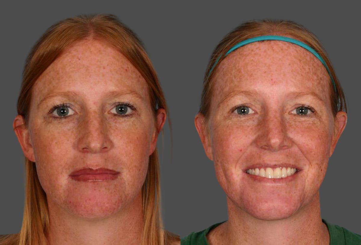 Rhinoplasty Before & After Gallery - Patient 280823 - Image 1