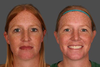 Rhinoplasty Before & After Gallery - Patient 280823 - Image 1