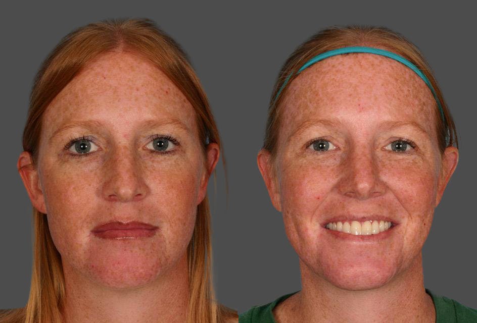 Rhinoplasty Before & After Gallery - Patient 280823 - Image 1