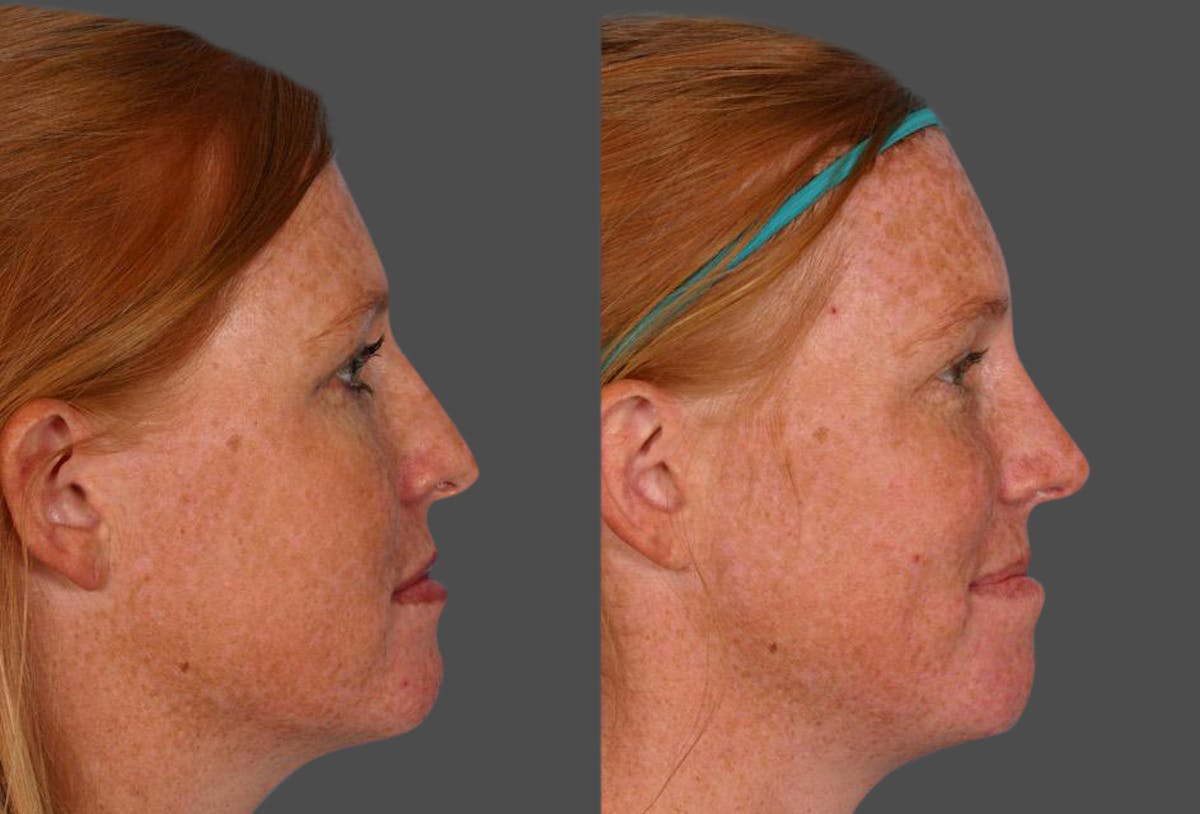 Rhinoplasty Before & After Gallery - Patient 280823 - Image 2
