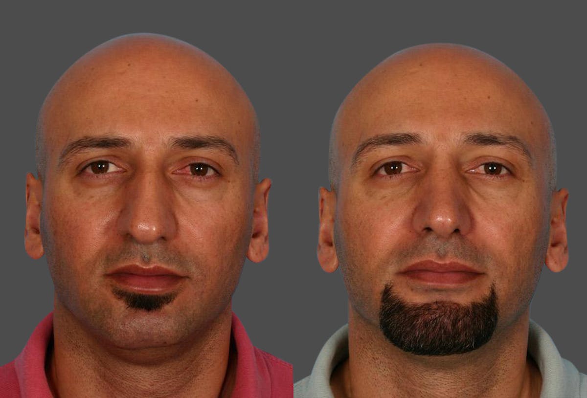 Nasal Obstruction Before & After Gallery - Patient 951222 - Image 1