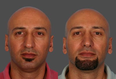 Rhinoplasty Before & After Gallery - Patient 260489 - Image 1