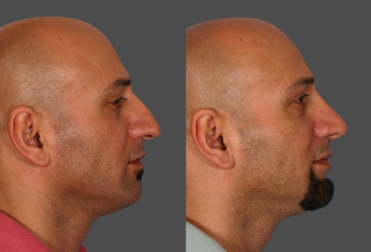 Nasal Obstruction Before & After Gallery - Patient 951222 - Image 2