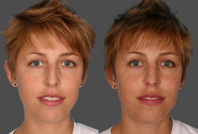 Nasal Obstruction Before & After Gallery - Patient 962609 - Image 1