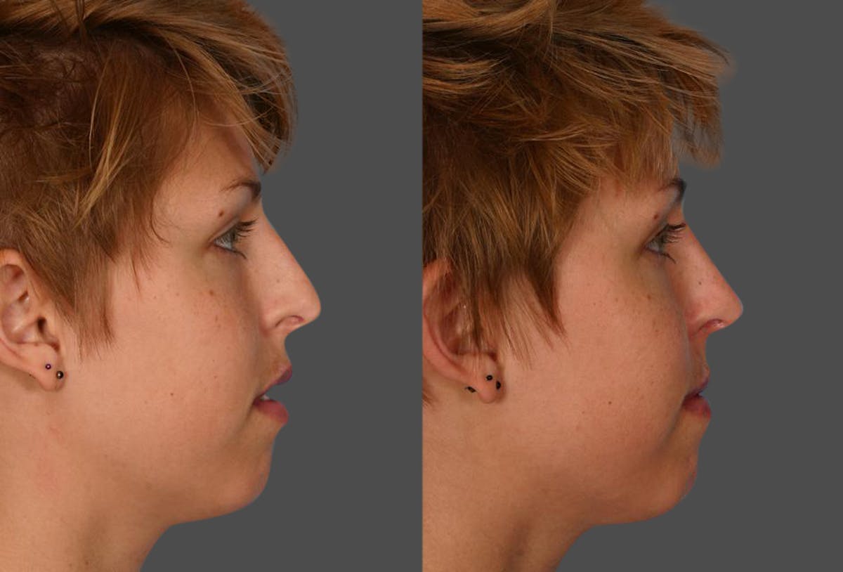 Nasal Obstruction Before & After Gallery - Patient 962609 - Image 2