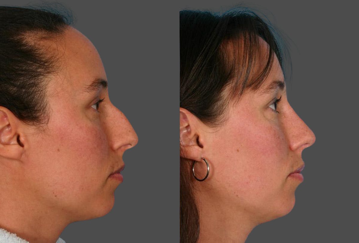 Nasal Obstruction Before & After Gallery - Patient 340901 - Image 2