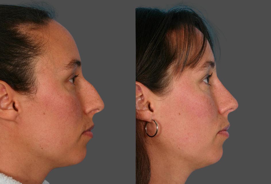 Rhinoplasty Before & After Gallery - Patient 133911 - Image 2