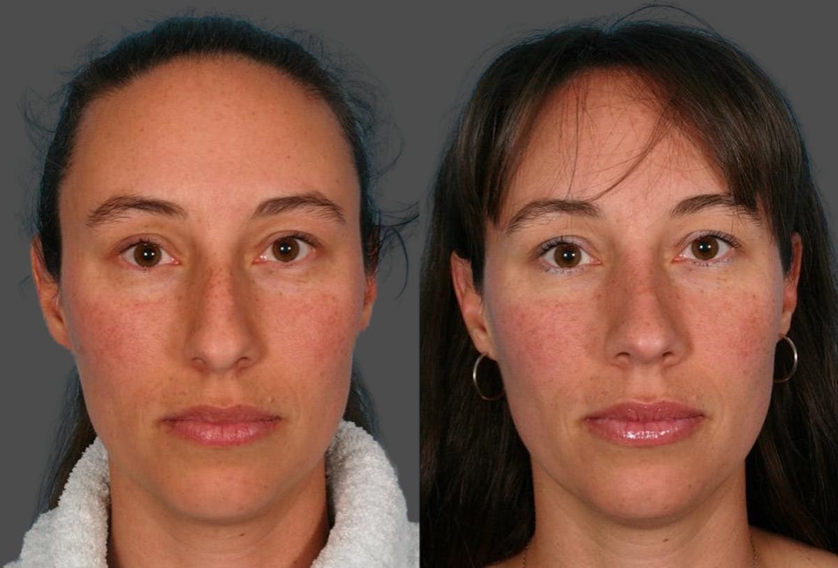 Nasal Obstruction Before & After Gallery - Patient 340901 - Image 1