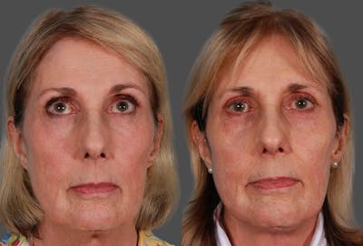 Neck Lift Before & After Gallery - Patient 264171 - Image 1