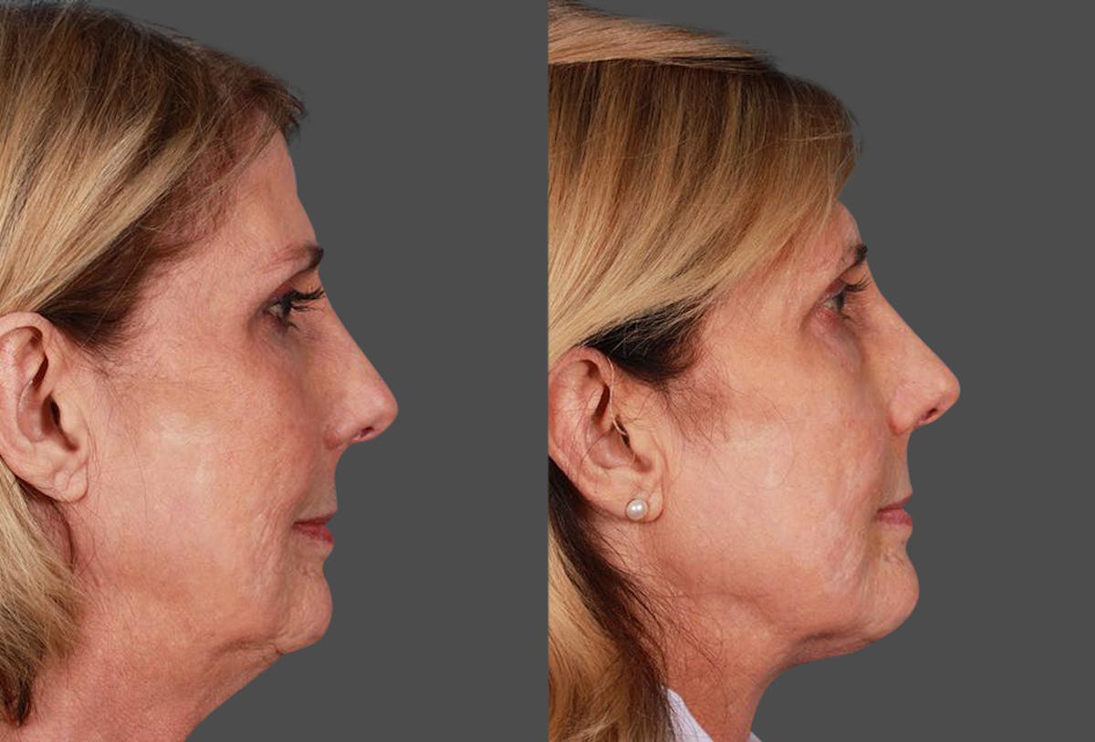Neck Lift Before & After Gallery - Patient 264171 - Image 2