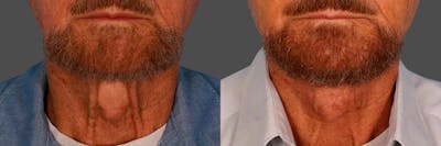 Neck Lift Before & After Gallery - Patient 399186 - Image 1