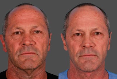 Neck Lift Before & After Gallery - Patient 683497 - Image 1