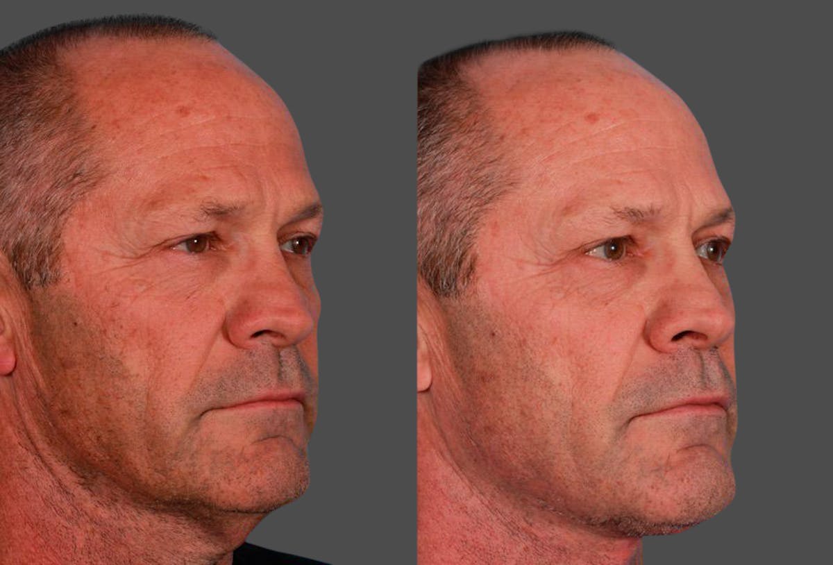 Neck Lift Before & After Gallery - Patient 683497 - Image 2