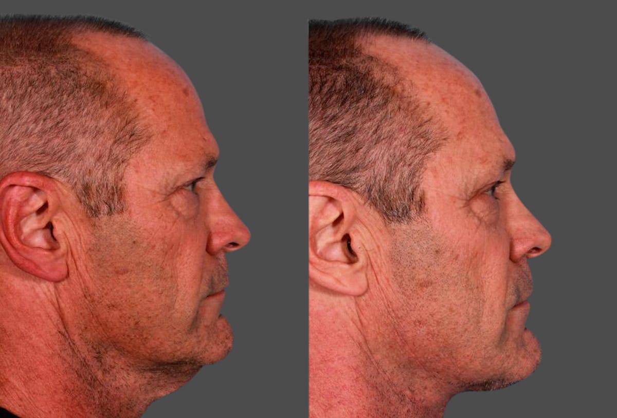 Neck Lift Before & After Gallery - Patient 683497 - Image 3