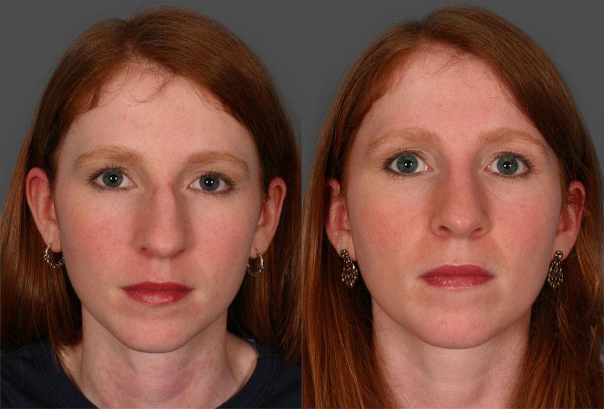 Rhinoplasty Before & After Gallery - Patient 100922 - Image 1