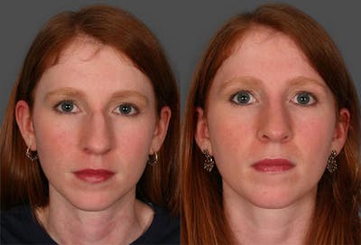 Rhinoplasty Before & After Gallery - Patient 100922 - Image 1
